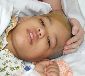 Hydrocelphalus Program Bulgaria